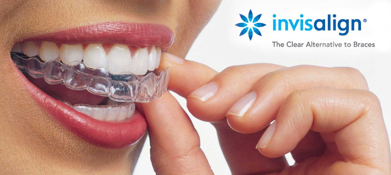 invisalign display