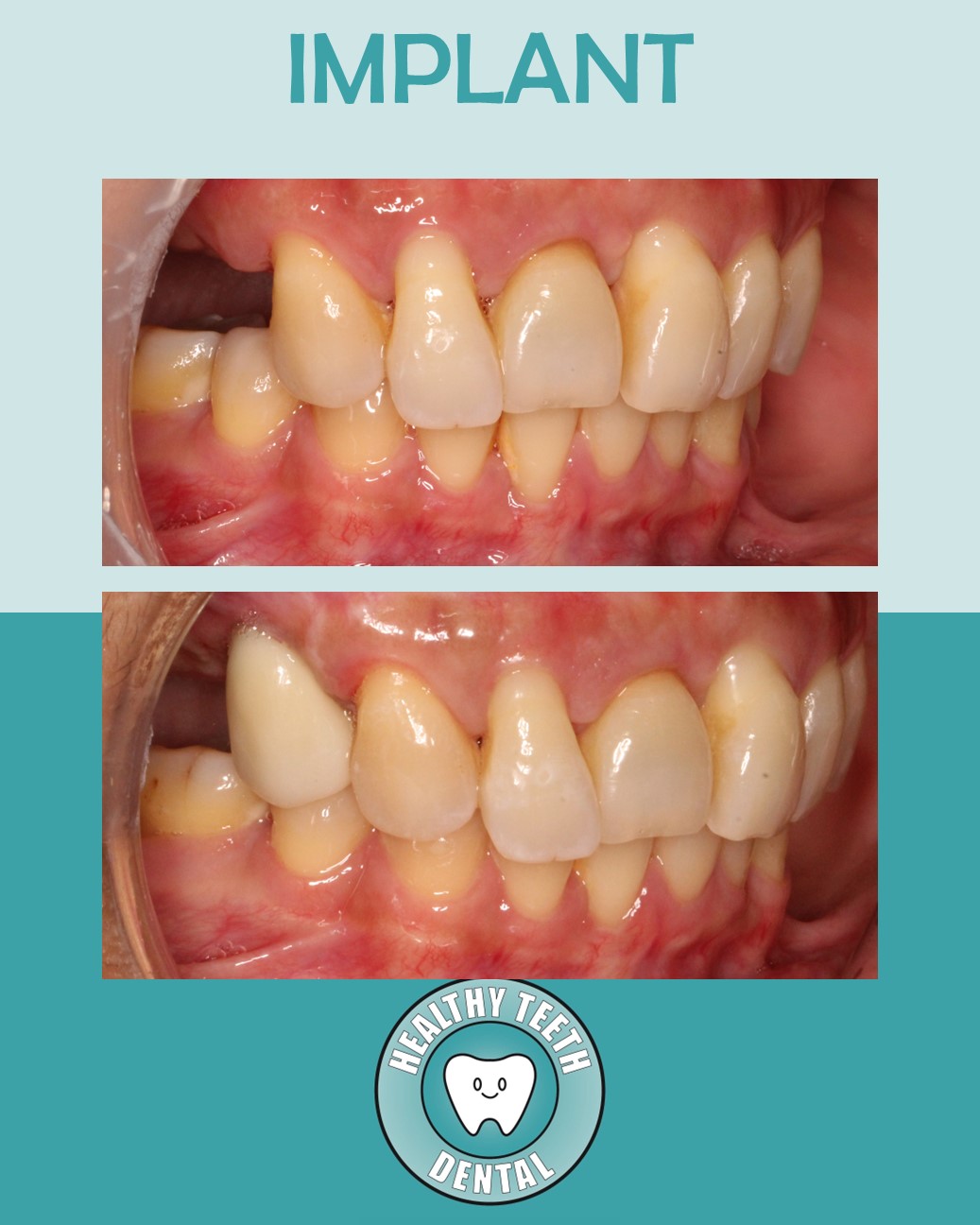 Before and after dental implant treatment showing tooth #5 restored with a single cement-retained implant crown