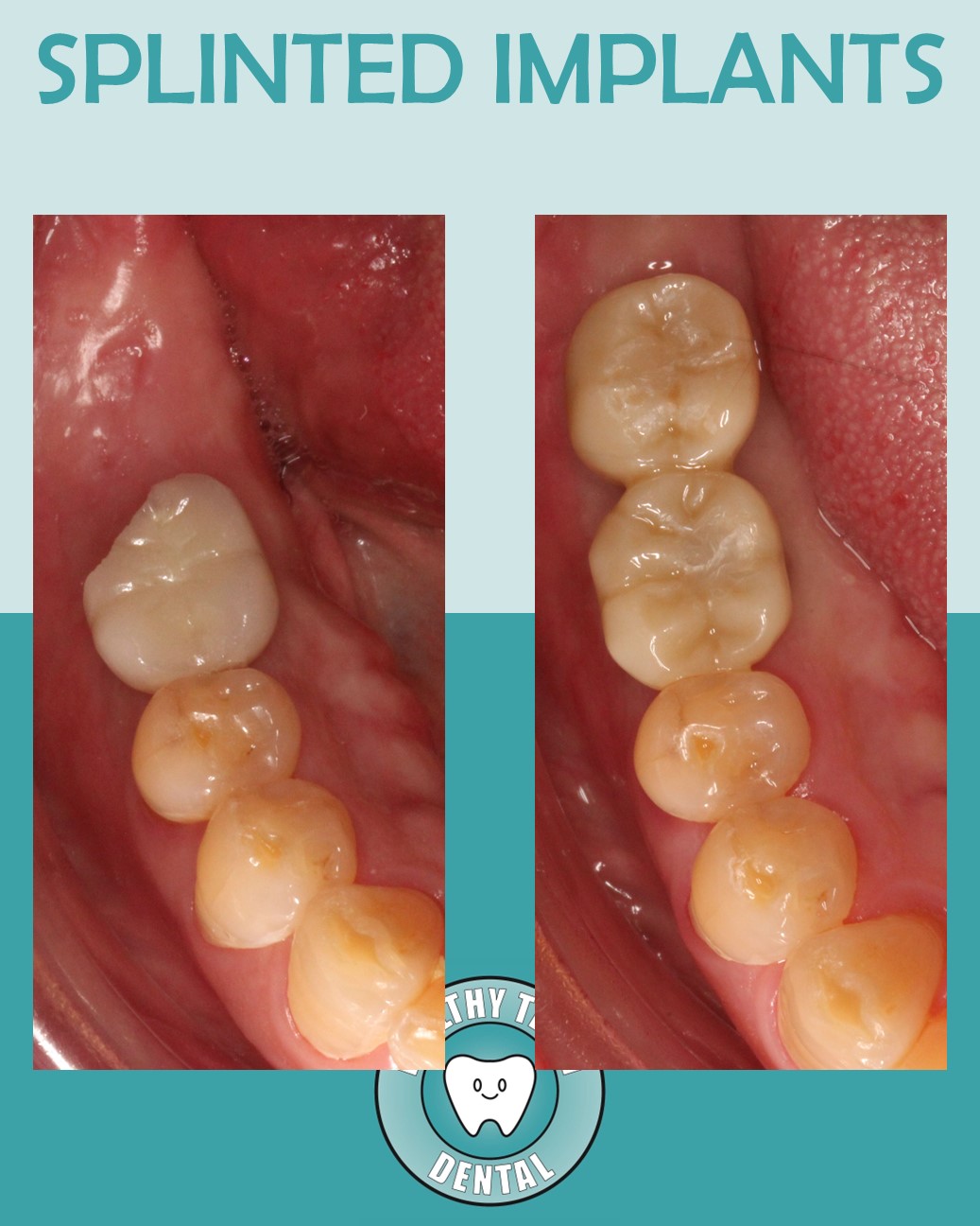 Before and after splinted implant crowns on teeth #30 and #31 at Healthy Teeth Dental in Anaheim, CA.