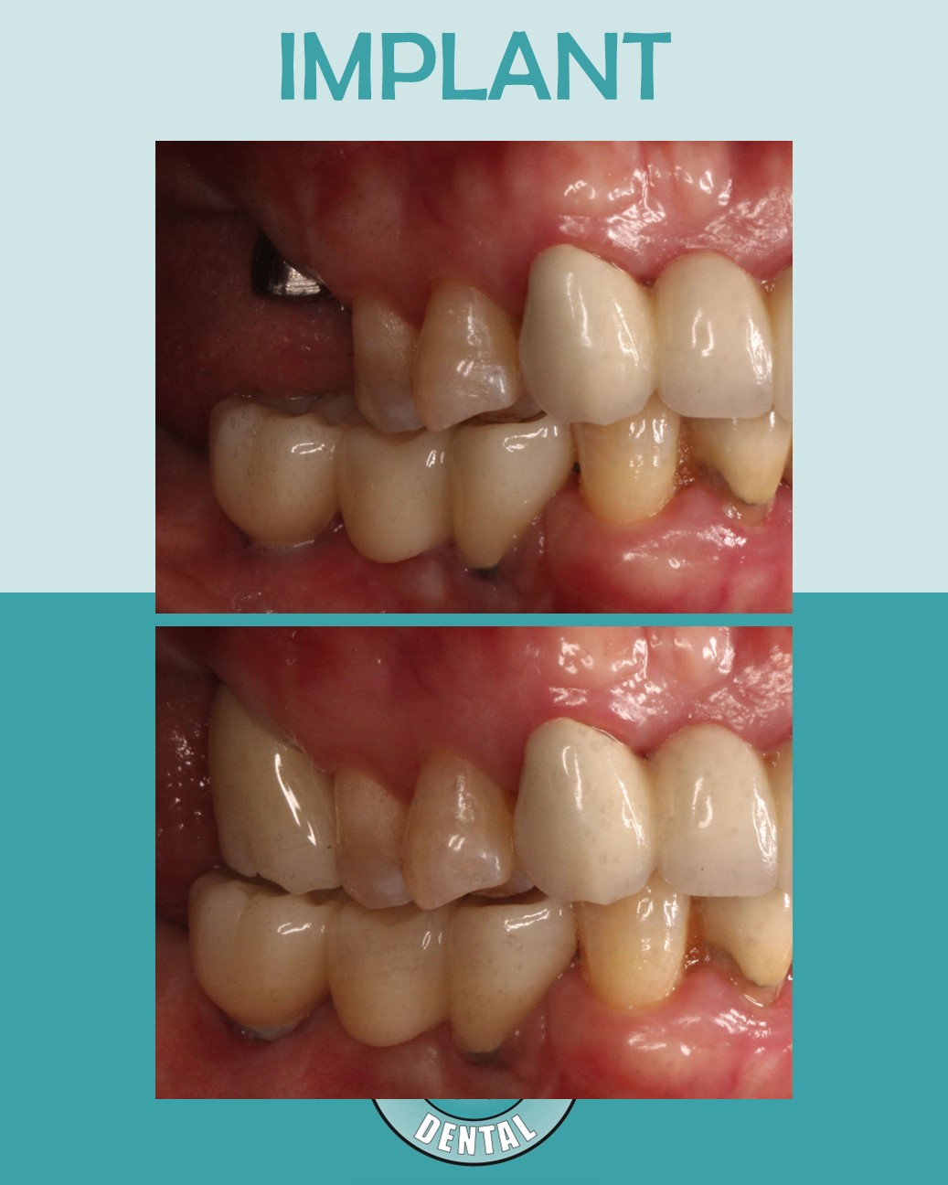 Tooth #3 dental implant crown restoration at Healthy Teeth Dental in Anaheim, CA.