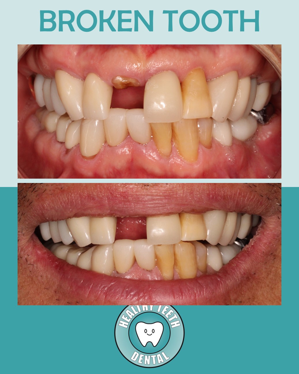 Broken front tooth #8 with the entire clinical crown fractured off at Healthy Teeth Dental in Anaheim, CA.