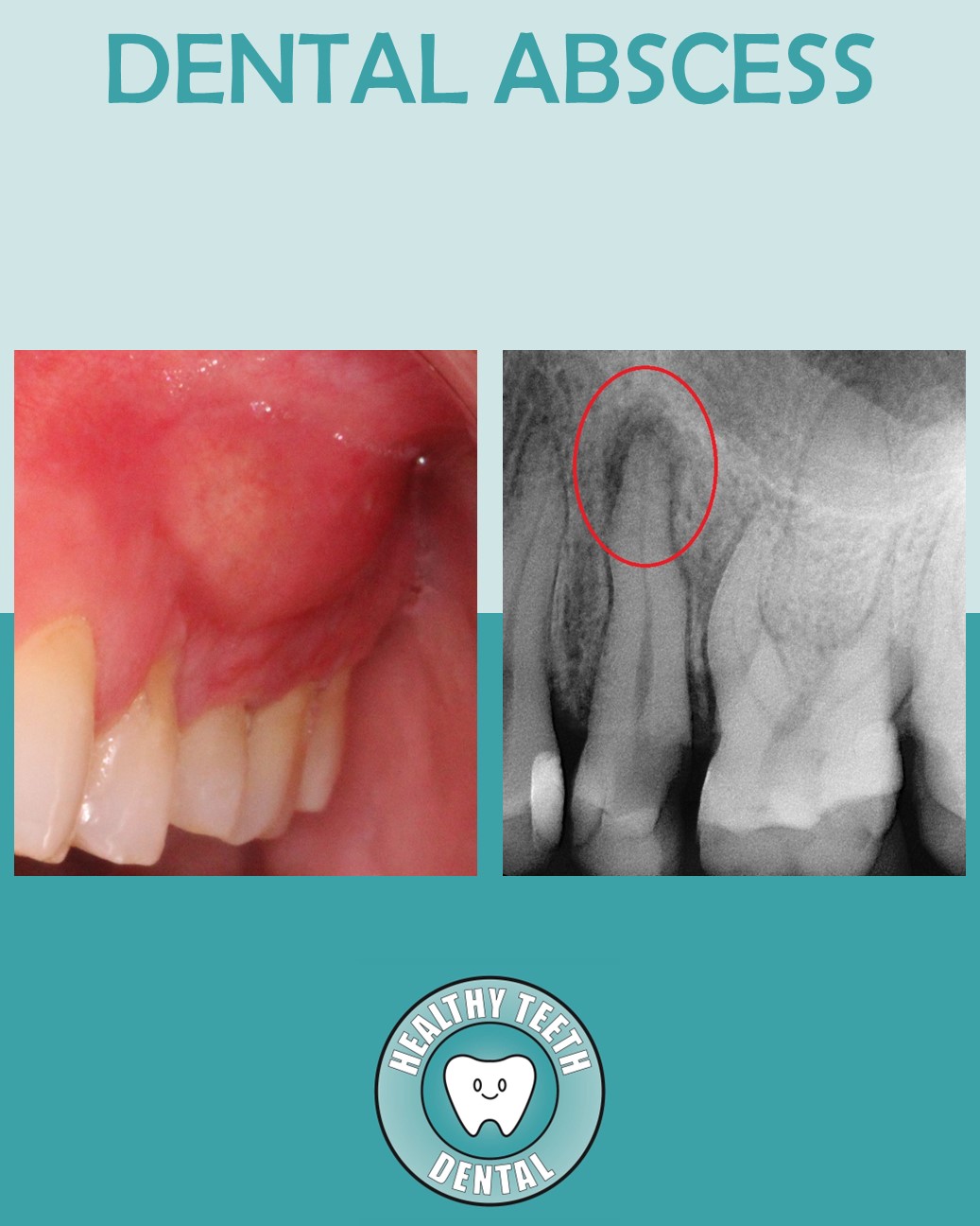Dental abscess associated with tooth #13 at Healthy Teeth Dental in Anaheim, CA.