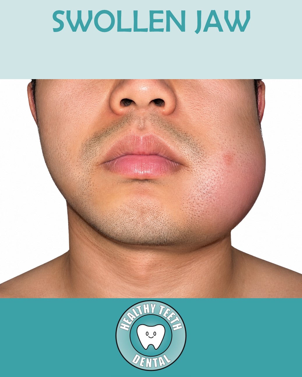 Swollen lower left jaw caused by a dental infection at Healthy Teeth Dental in Anaheim, CA.
