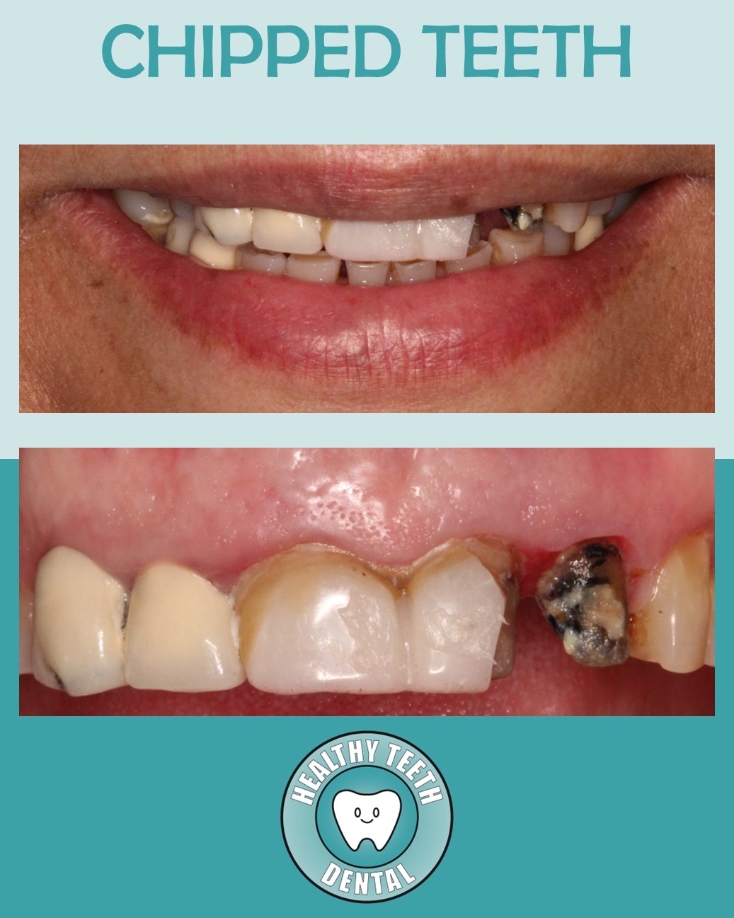 Chipped front teeth #9 and #10 shown in smile and close-up views at Healthy Teeth Dental in Anaheim, CA.