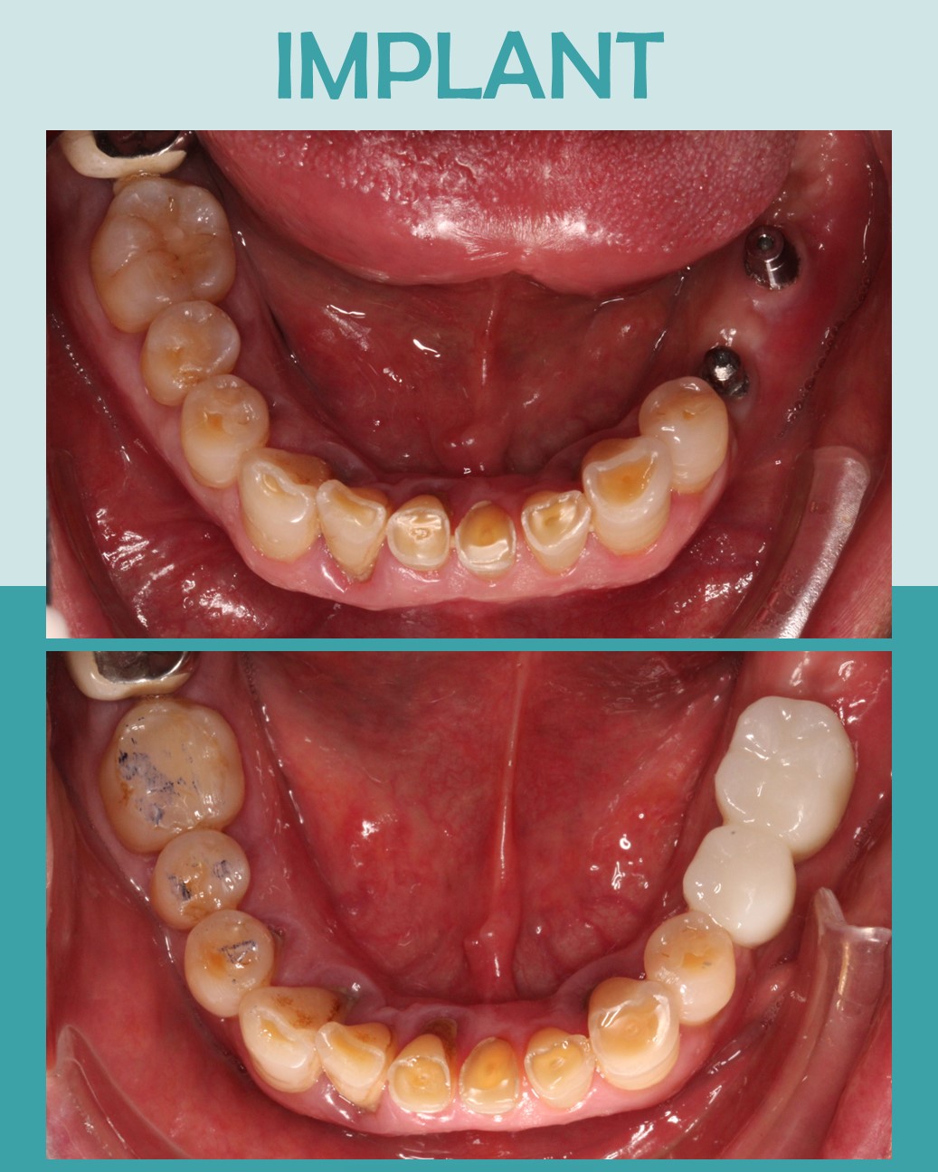 Before and after lower arch view showing two dental implant restorations