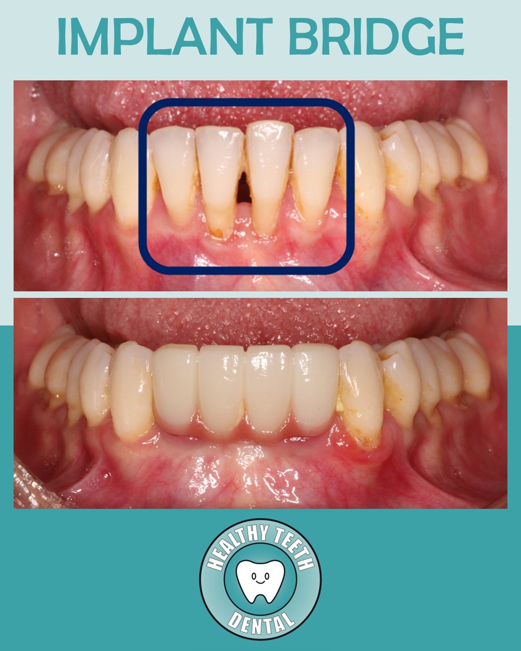 Before and after implant-supported bridge treatment for lower front teeth with severe bone loss and gum recession