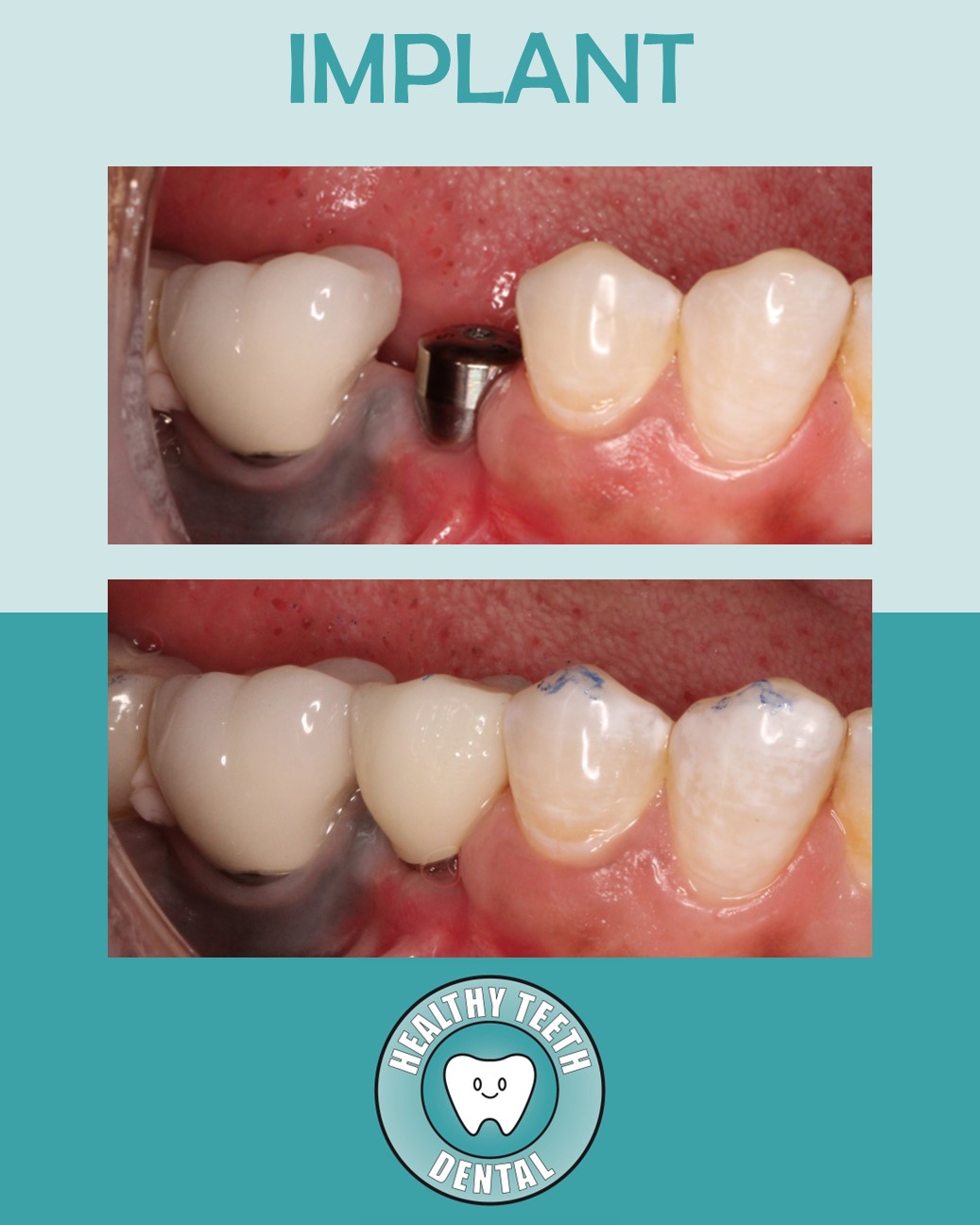 Before and after dental implant restoration replacing tooth #29