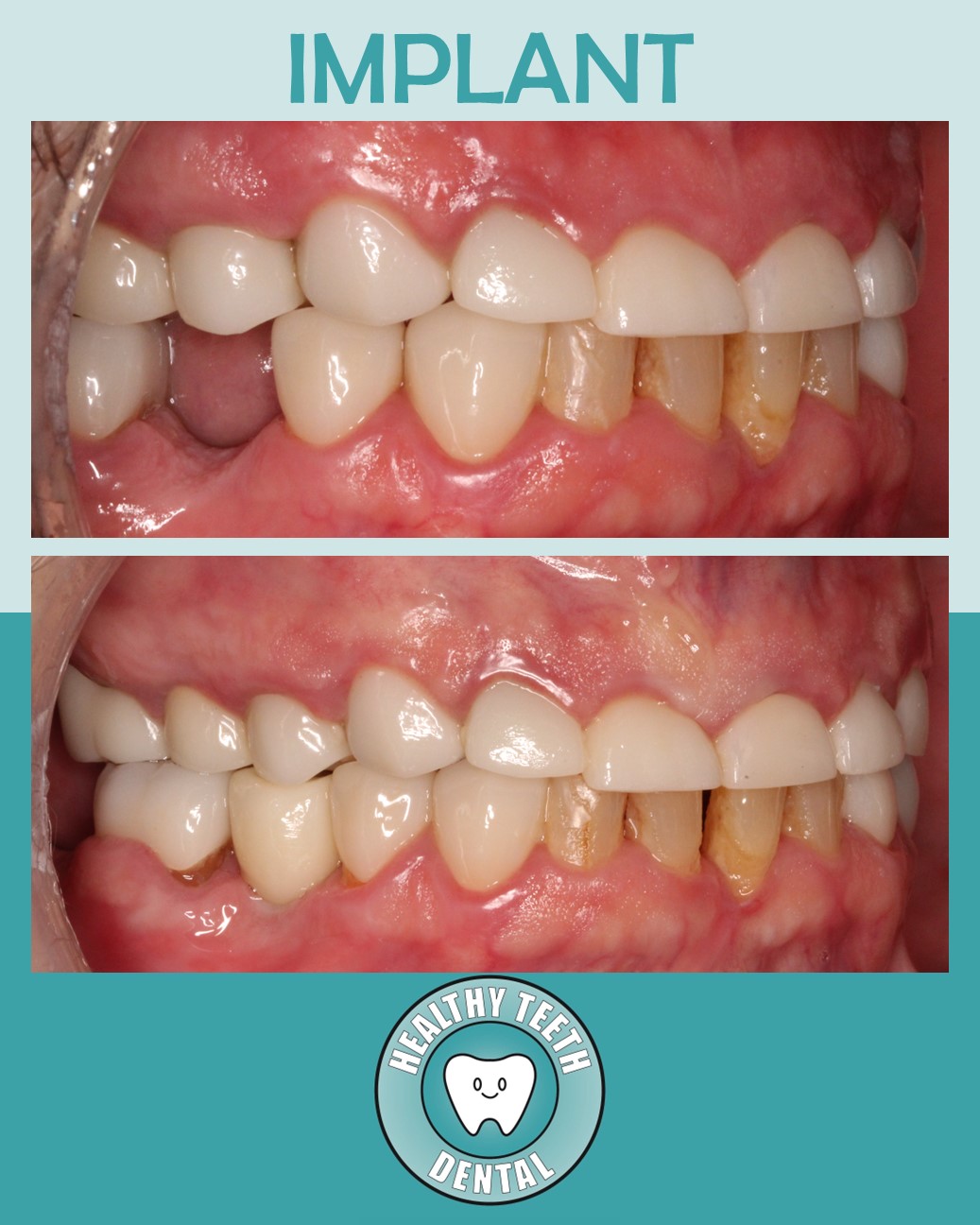 Before and after side view of dental implant restoration replacing tooth #29