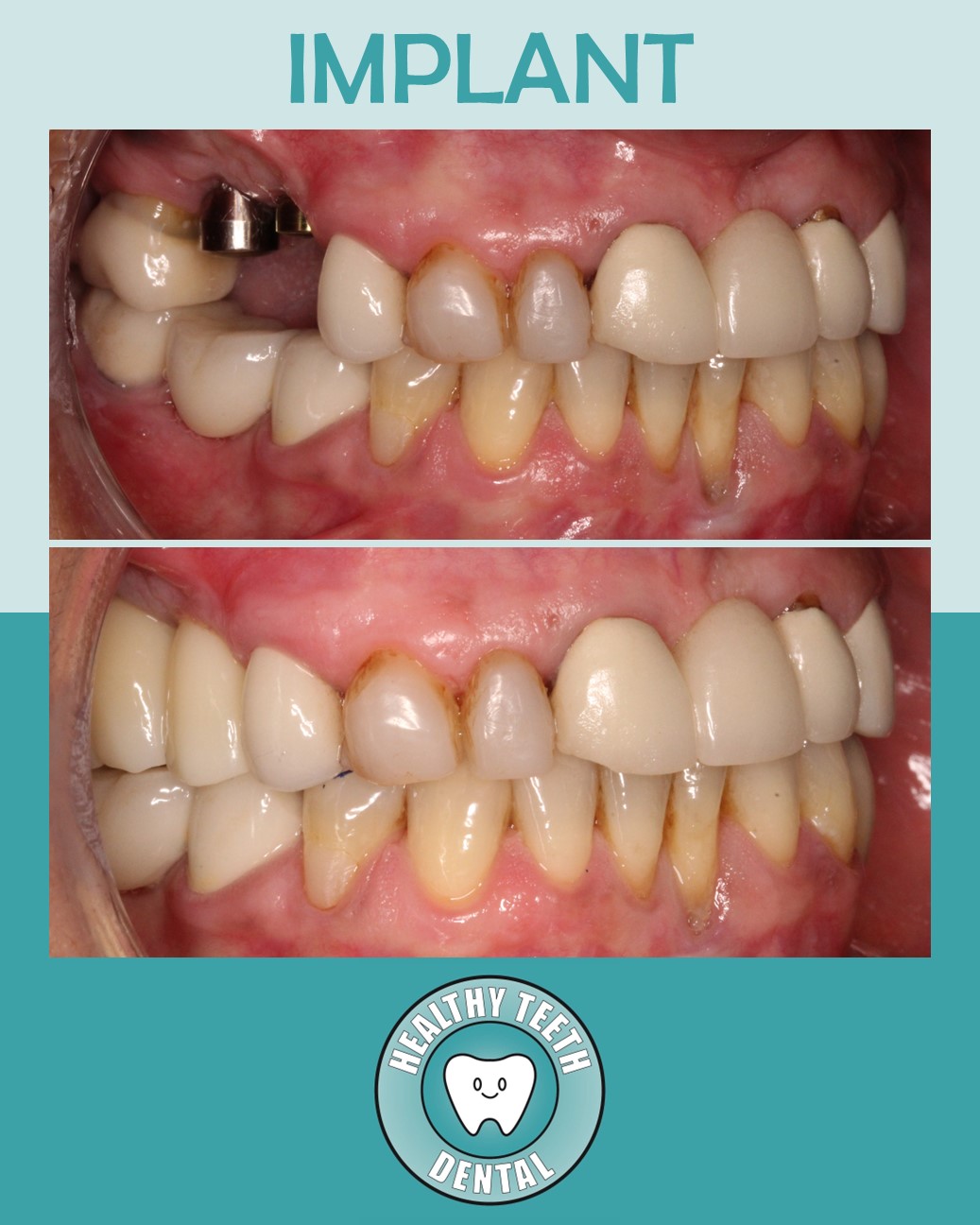 Before and after dental implant treatment replacing two missing teeth