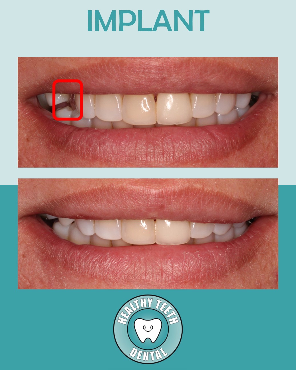 Before and after smile showing a dental implant replacing a missing front tooth