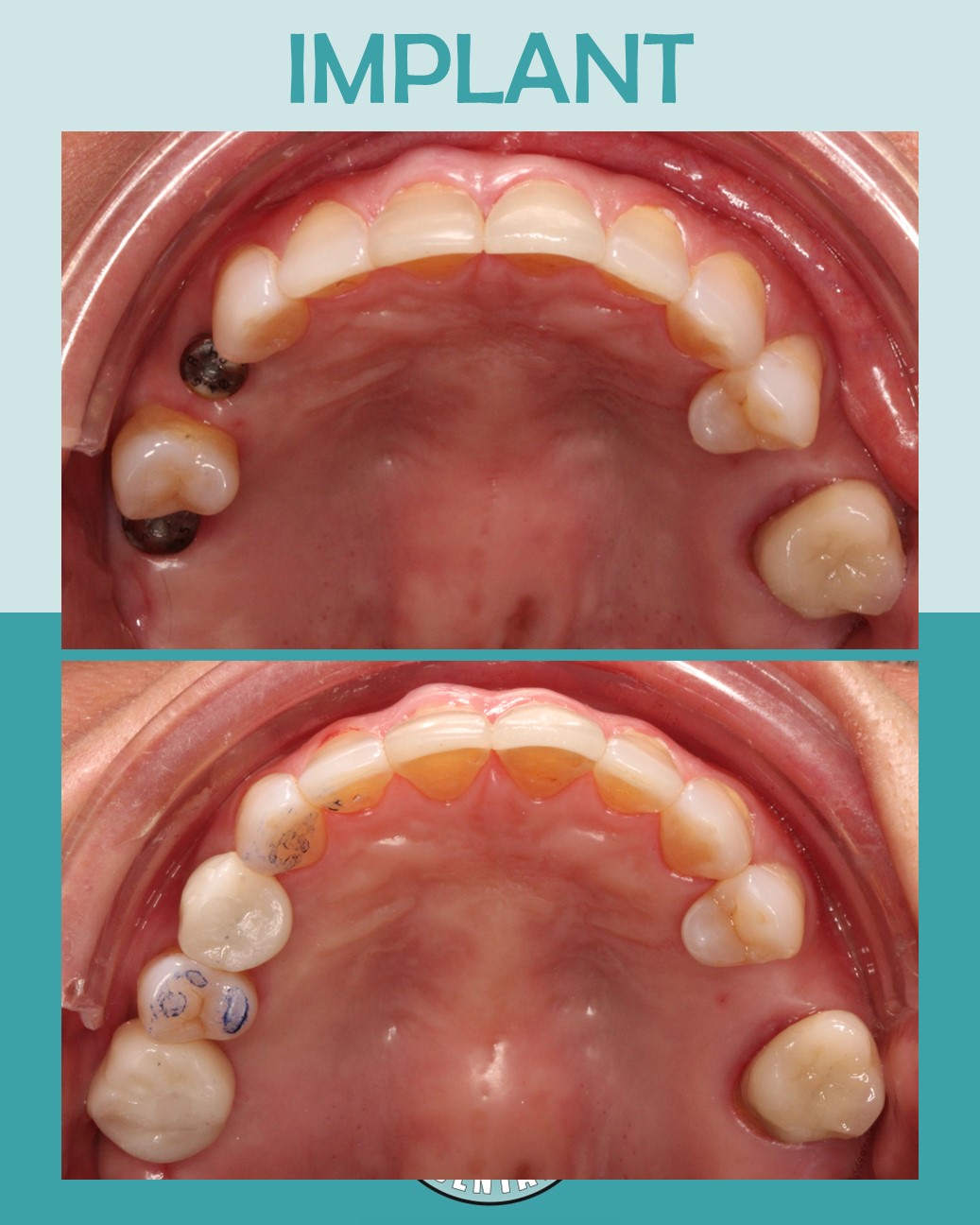 Before and after upper arch view of dental implant treatment replacing missing teeth