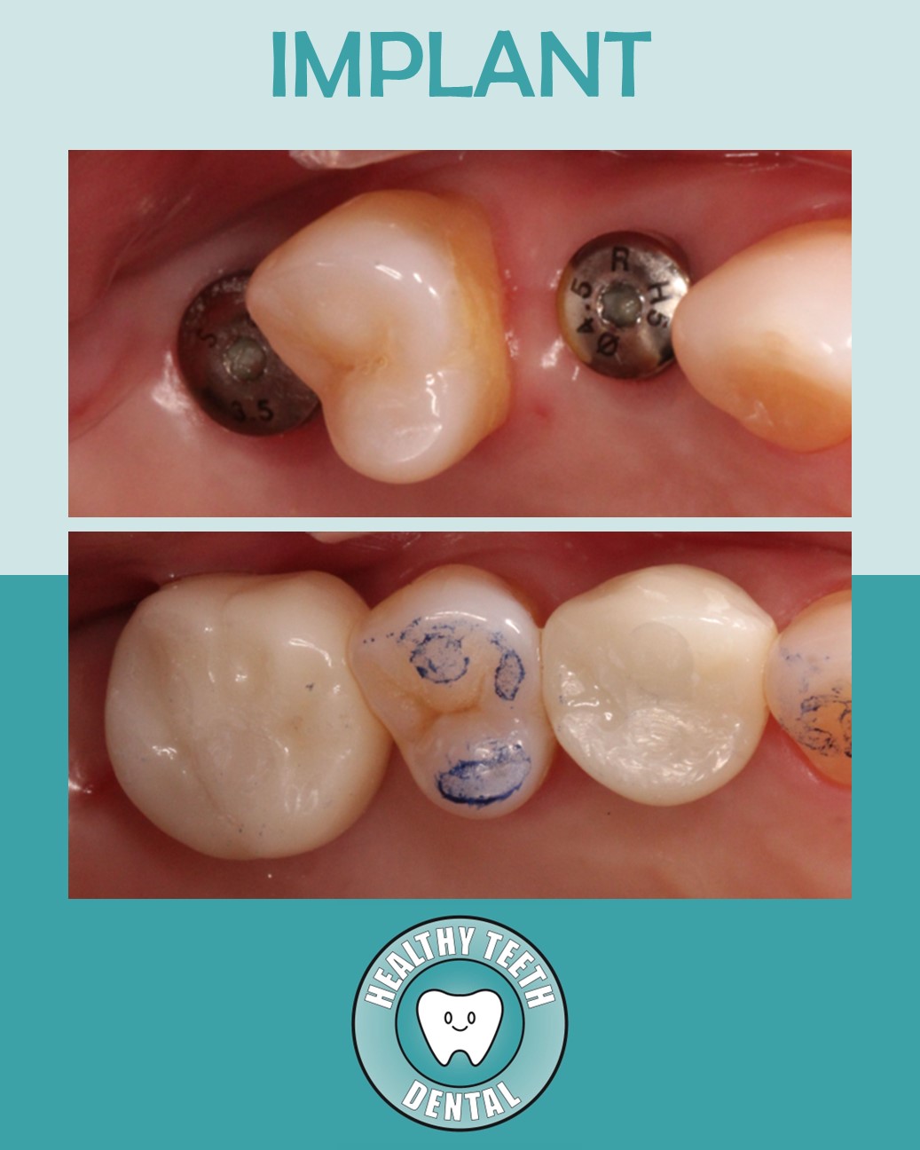 Before and after close-up of dental implant placement and restored back tooth