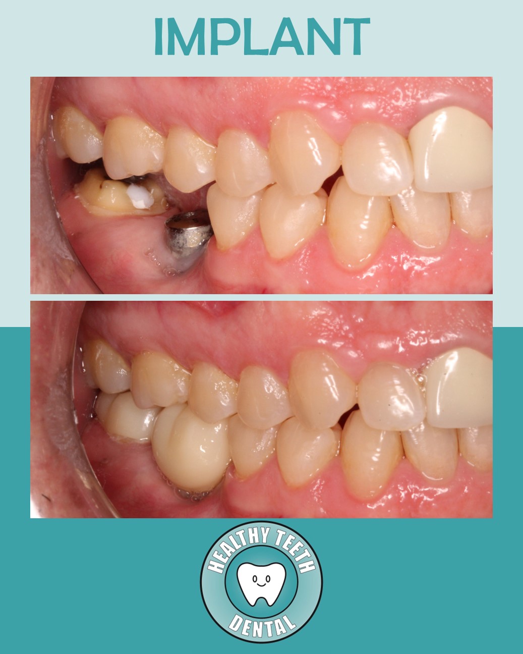Before and after dental implant #30 and crown #31