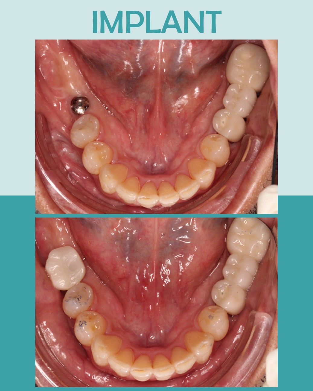Before and after lower arch view of dental implant restoration replacing tooth #30