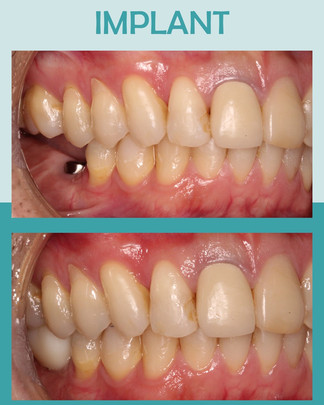 Before and after side view of dental implant restoration replacing tooth #30