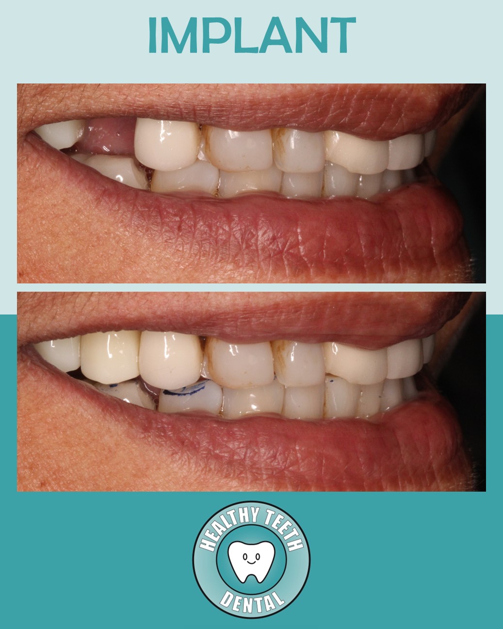 Before and after smile showing dental implant restoration of a missing upper tooth