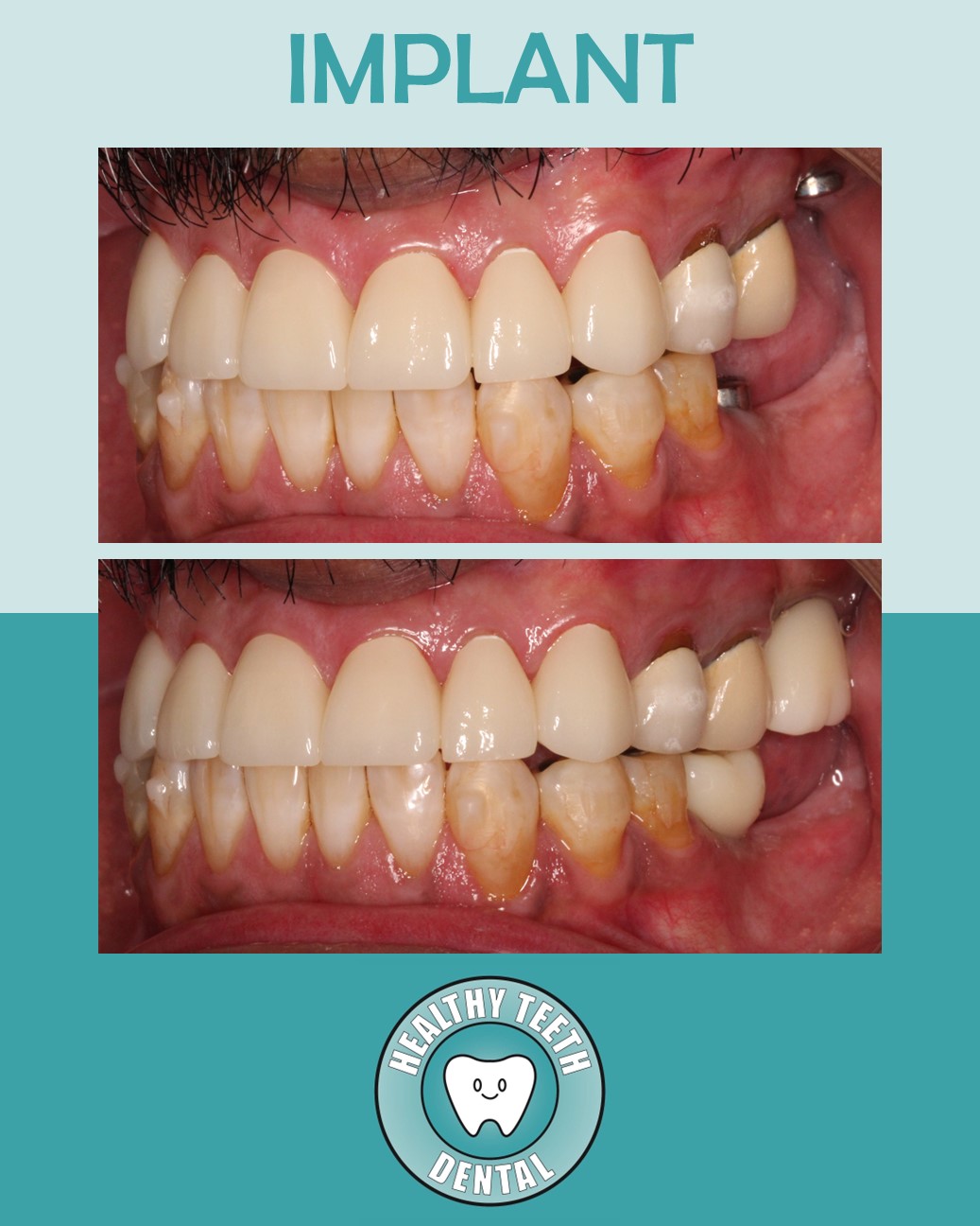 Before and after side view of multiple dental implant restorations
