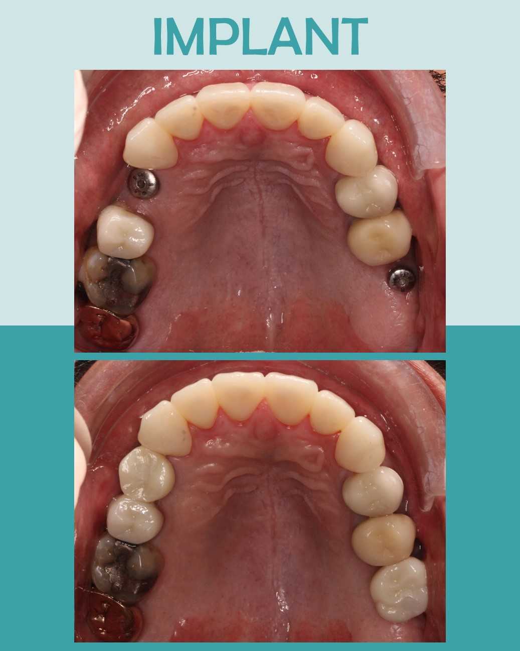 Before and after upper arch view of multiple dental implant restorations