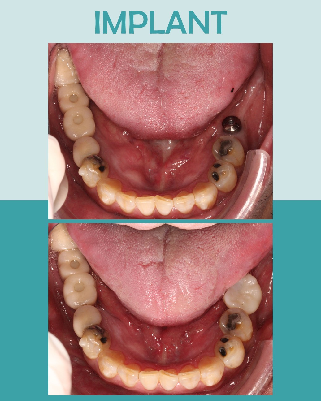 Before and after lower arch view of multiple dental implant restorations