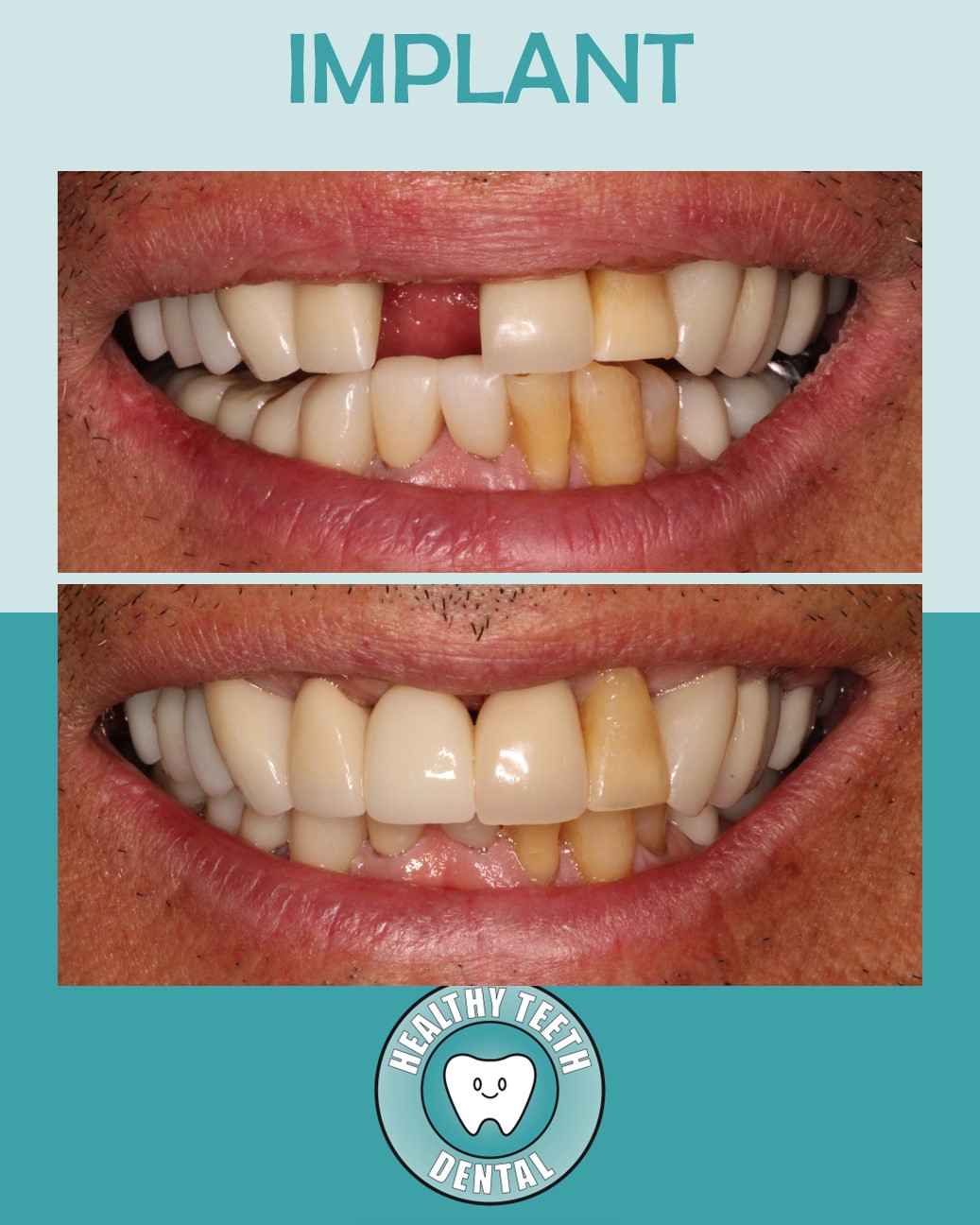 Before and after smile showing dental implant restoration of missing front teeth