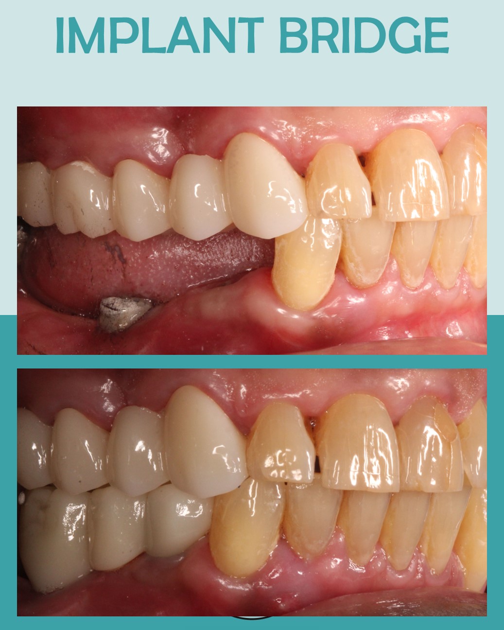 Before and after side view of implant-supported bridge restoring teeth #28–30
