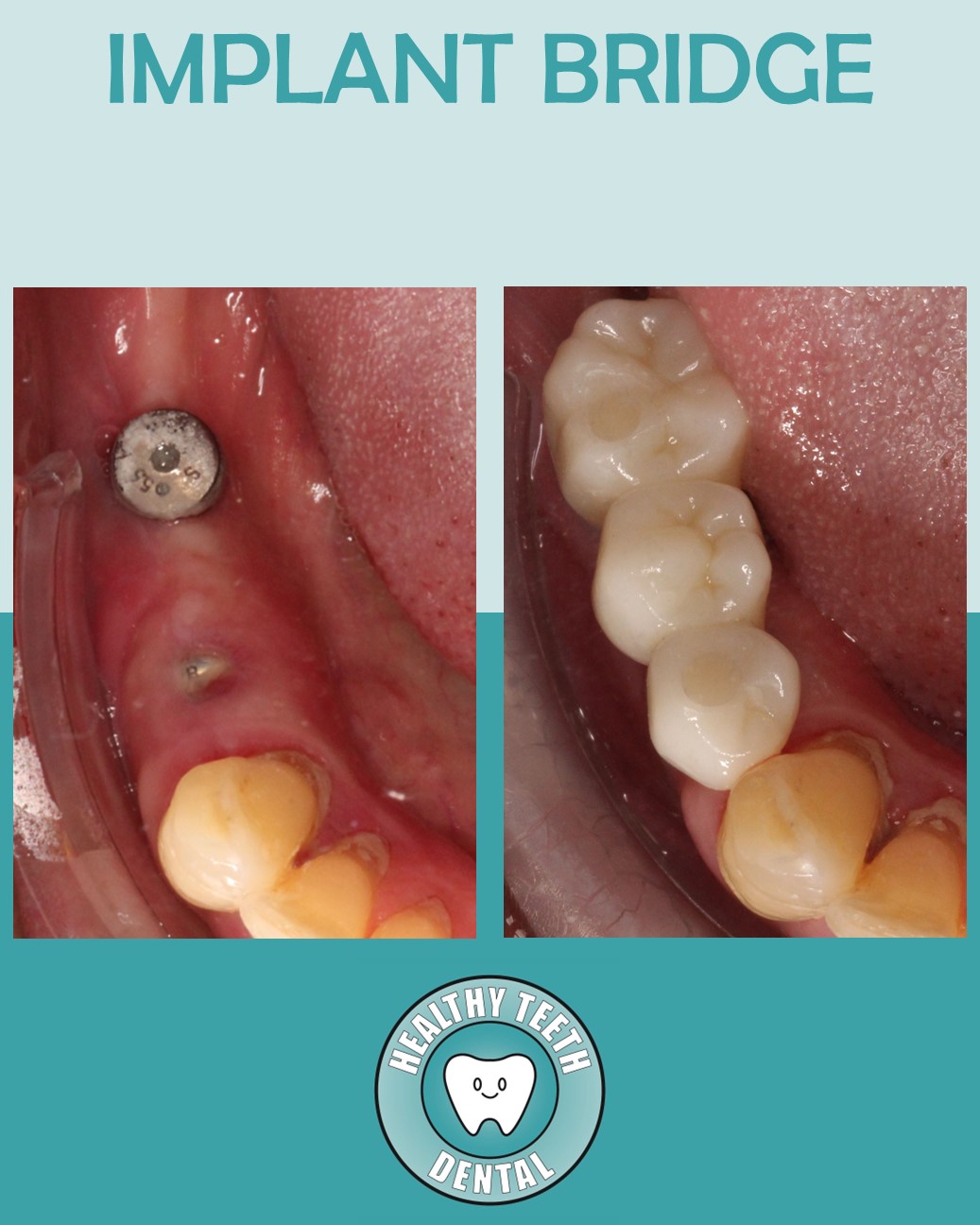 Before and after occlusal view of implant-supported bridge restoring teeth #28–30