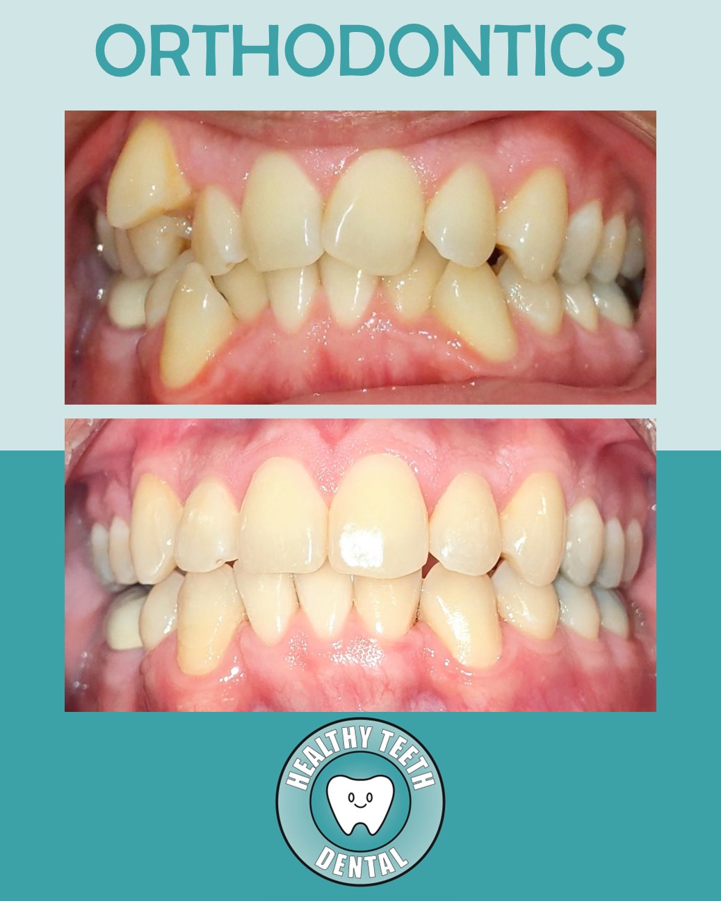 Before and after frontal view showing improved tooth alignment after orthodontic treatment