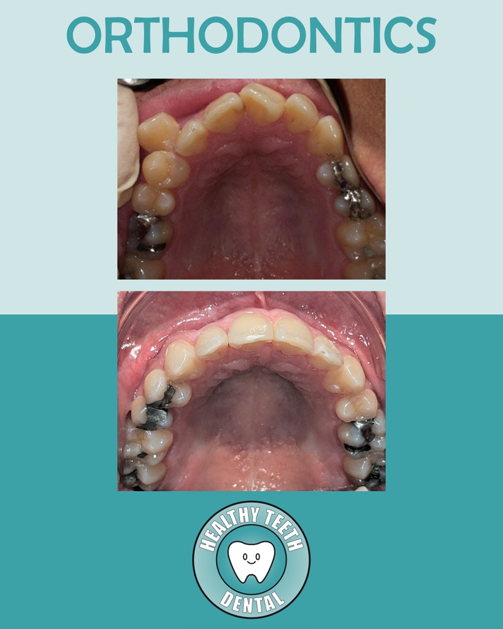 Before and after upper arch view showing improved tooth alignment after orthodontic treatment
