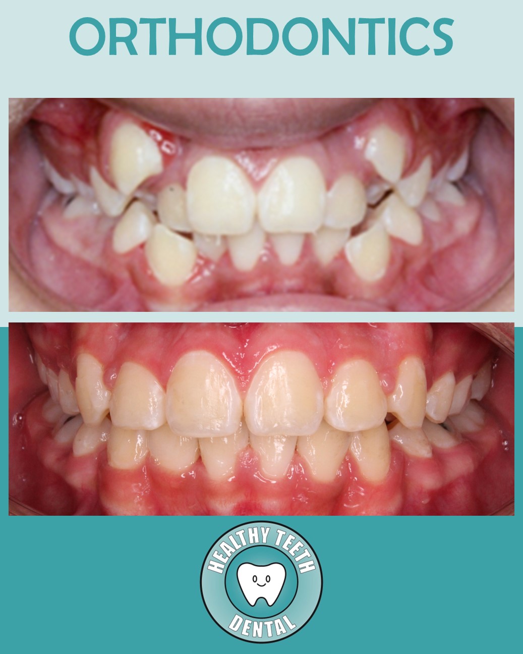 Before and after frontal view showing improved tooth alignment after orthodontic treatment