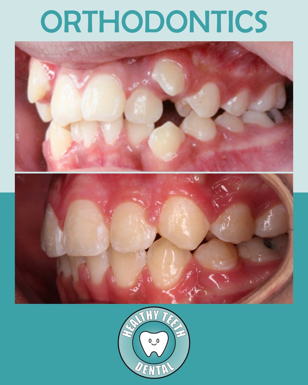 Before and after side view showing improved tooth alignment after orthodontic treatment