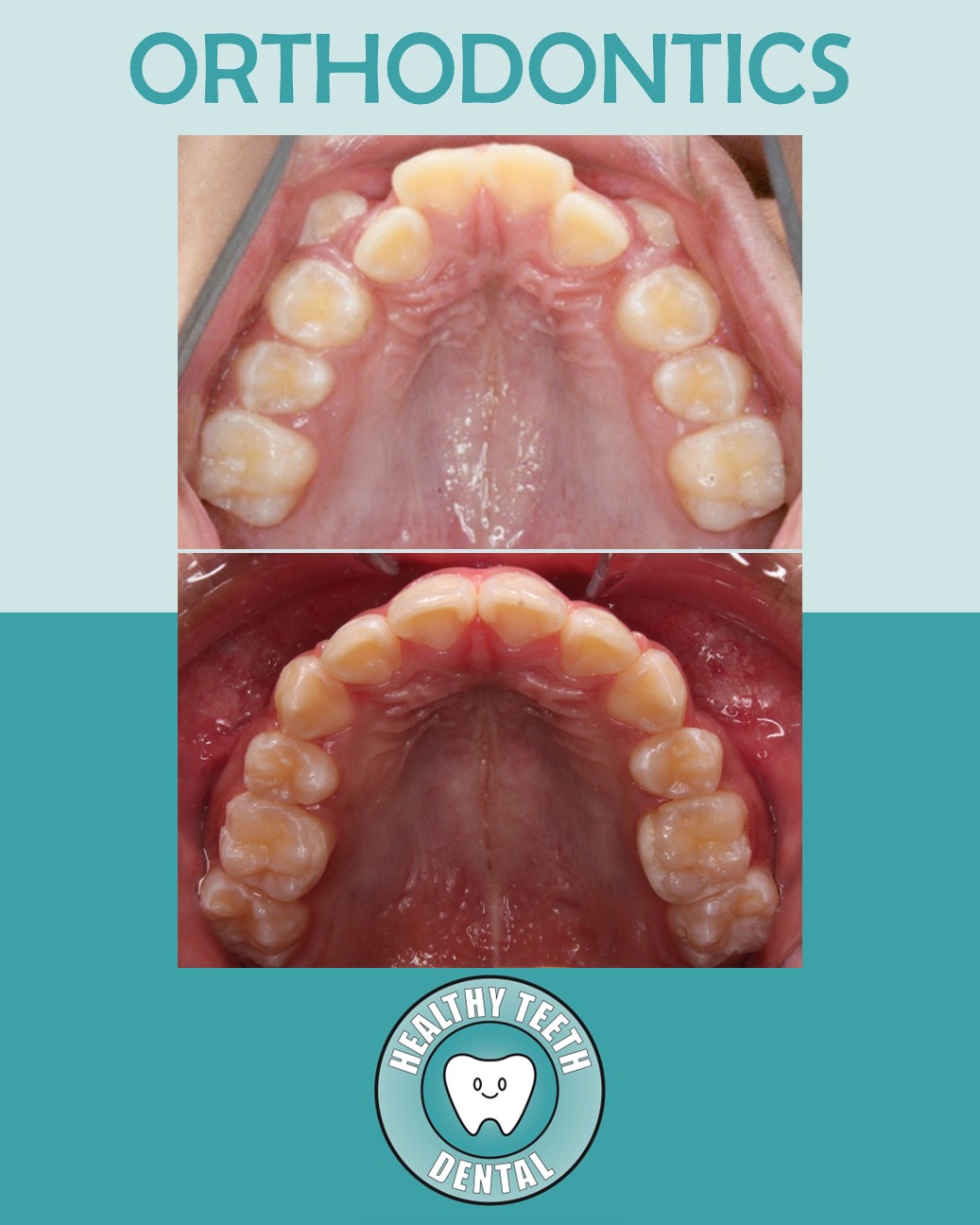 Before and after upper arch view showing improved tooth alignment after orthodontic treatment