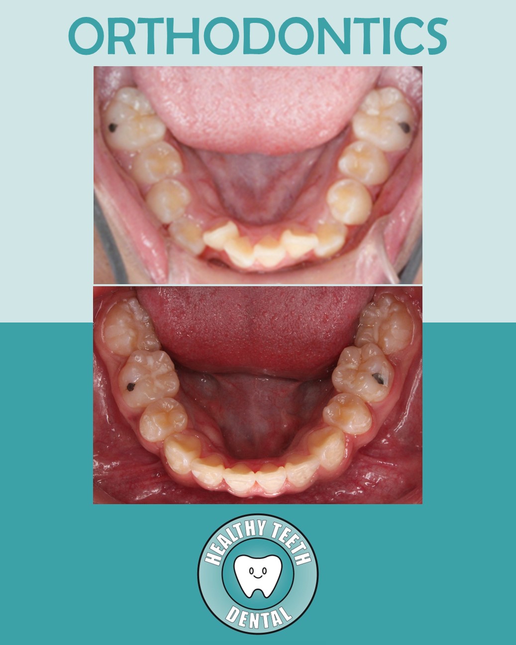 Before and after occlusal view of orthodontic treatment for lower teeth crowding
