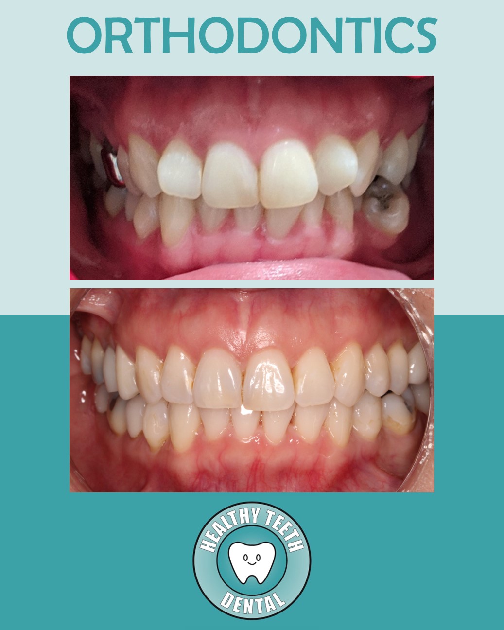 Before and after orthodontic treatment for lower teeth crowding with extraction of tooth #20