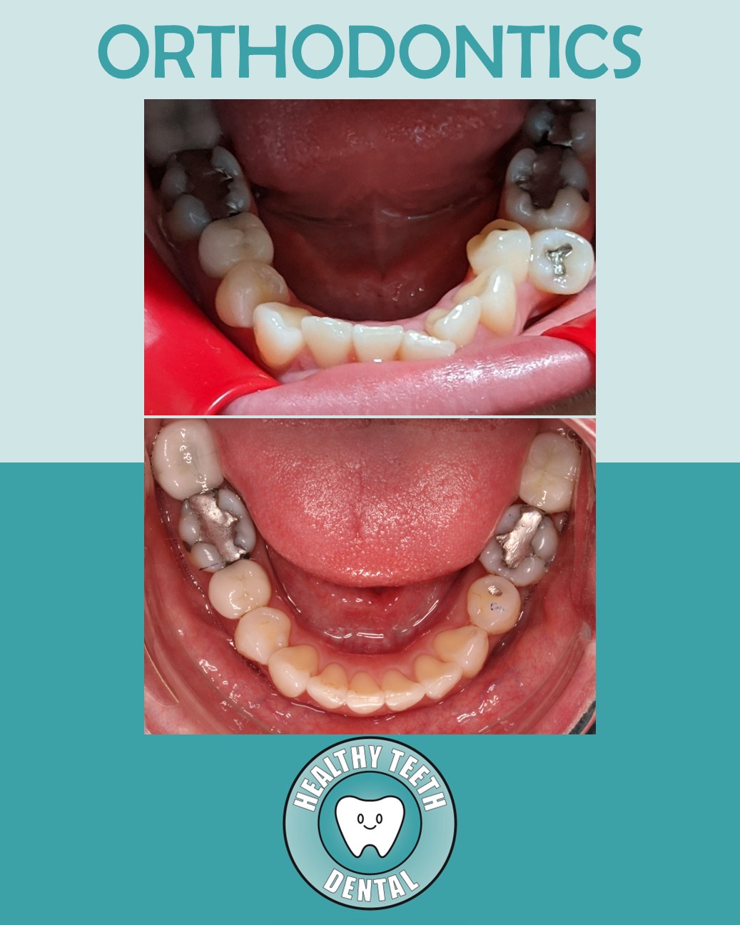 Before and after orthodontic treatment with tooth #20 removed to relieve lower teeth crowding