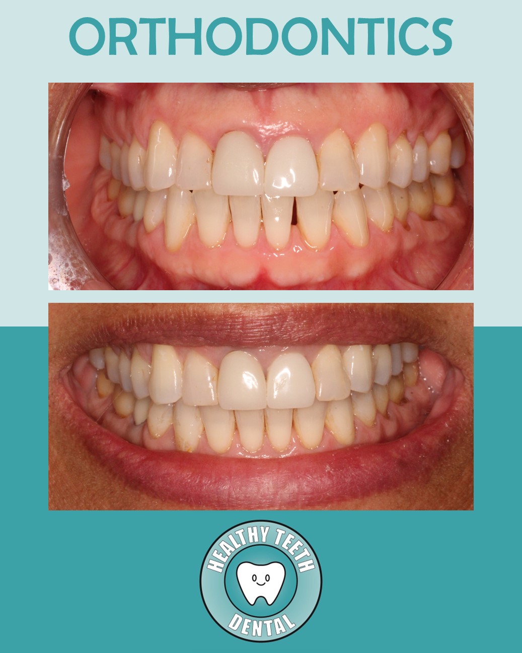 Before and after orthodontic treatment closing space between teeth #23 and #24