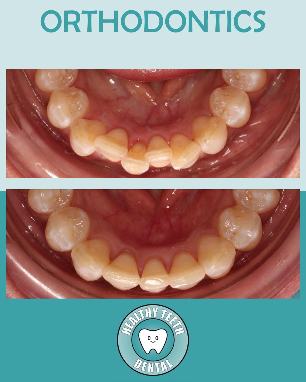 Before and after orthodontic treatment for crowded lower teeth
