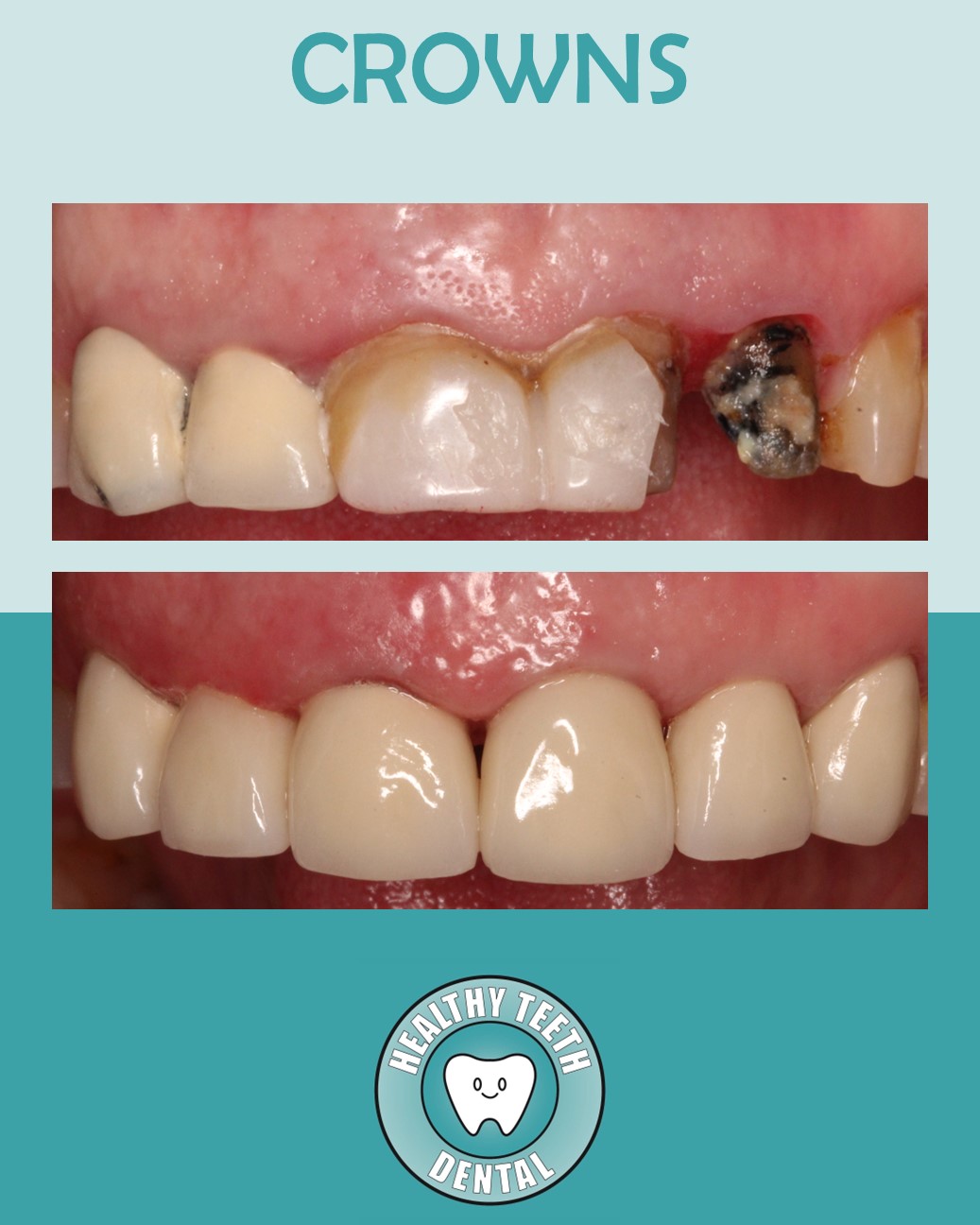 Before and after photo of crowns on upper front teeth #6–11, restoring the patient’s smile.