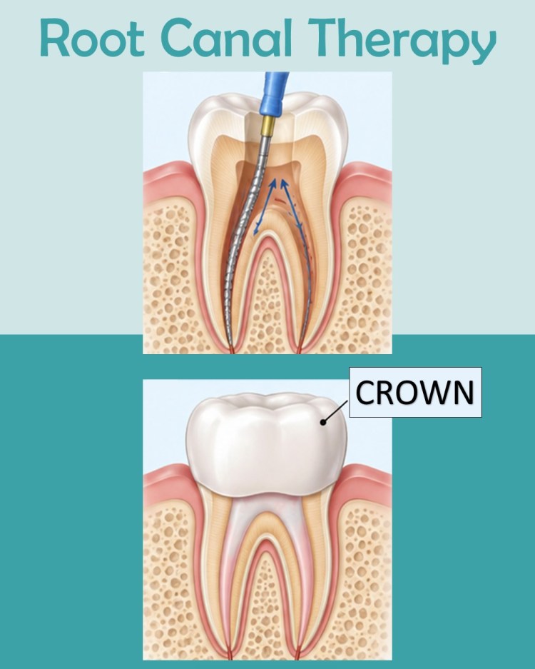 Root canal treatment illustration showing removal of infected pulp, cleaning of the root canals, and placement of a dental crown.